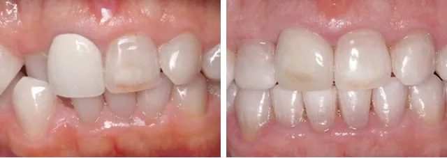 Cosmetic Makeover Before After 1 Watkin Dental Associates