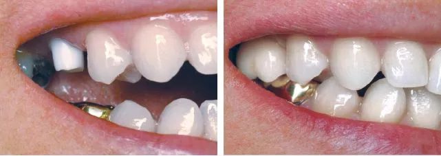 Smiles Gallery 5 Dental Implants Before After Watkin Dental Associates