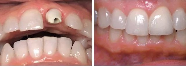 Smiles Gallery 9 Missing A Tooth Before After Watkin Dental Associates