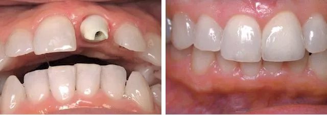 Missing A Tooth Before After Watkin Dental Associates