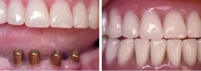 Smiles Gallery 10 Missing Bottom Teeth Before After Watkin Dental Associates
