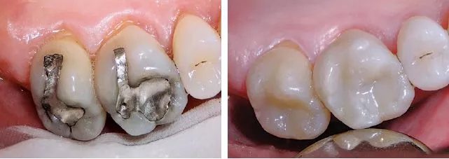 Smiles Gallery 2 Replacement Fillings Beofe And After 3 Watkin Dental Associates