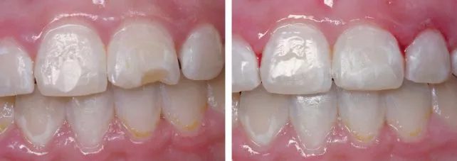 chipped tooth Before After Watkin Dental Associates