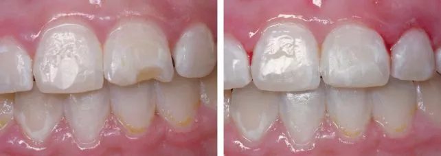 Smiles Gallery 13 chipped tooth Before After Watkin Dental Associates