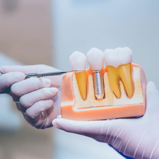 Dental Implants in Fitchburg
