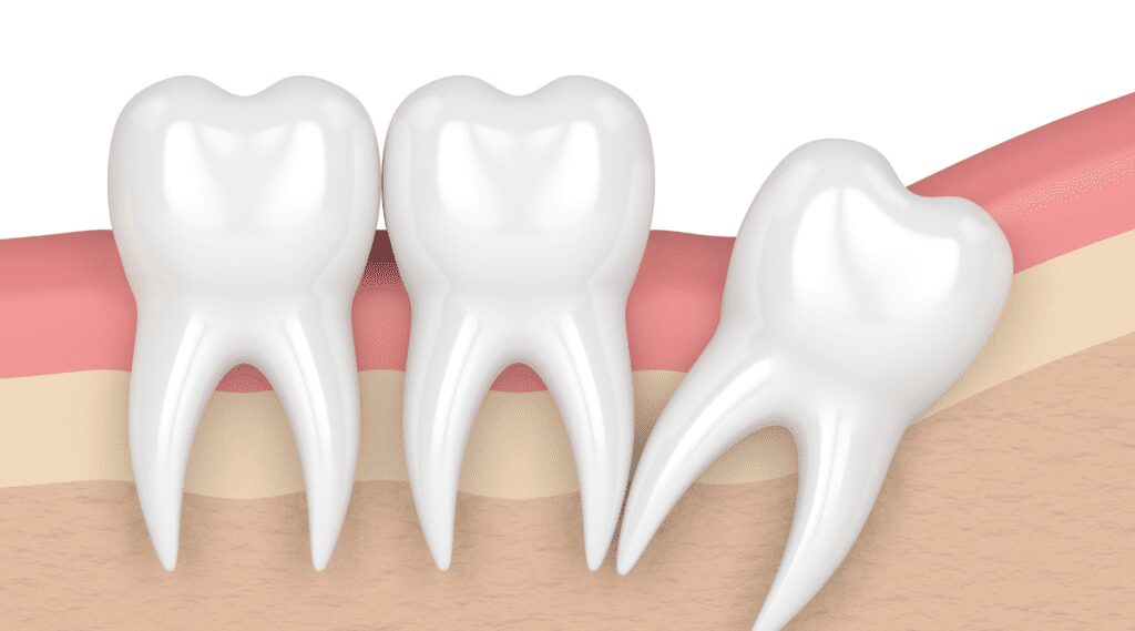 wisdom teeth removal in fitchburg