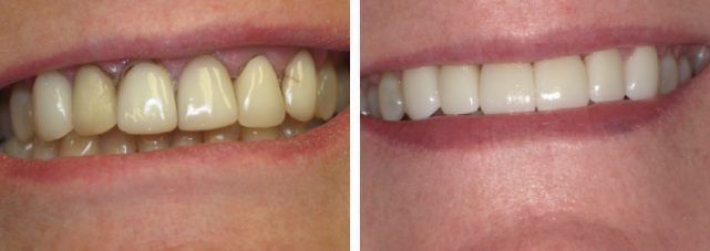 Smiles Gallery 17 Untitled 2 1 Watkin Dental Associates
